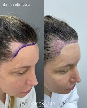Мужская пересадка волос в височную зону до и сразу после. Работа Ивана Павловича Чесалина
