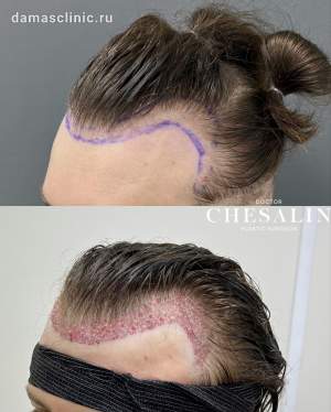 Мужская пересадка волос в височно-лобную зону без сбривания волос. Работа Ивана Павловича Чесалина