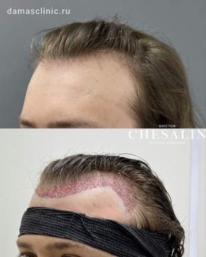 Мужская пересадка волос в височно-лобную зону без сбривания волос. Работа Ивана Павловича Чесалина
