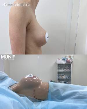 Реэндопротезирование груди: удаление старых имплантов и увеличение груди новыми. Первая операция проводилась у сторонних специалистов. Работа Мунифа Хальдуна Ахмадовича