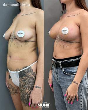 Увеличение груди имплантами с подтяжкой по ареоле одномоментно. Работа Мунифа Хальдуна Ахмадовича