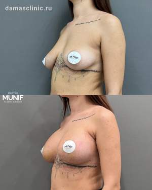 Увеличение груди имплантами с подтяжкой по ареоле одномоментно. Работа Мунифа Хальдуна Ахмадовича