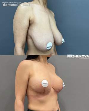 Редукционная подтяжка груди без имплантов, с сохранением объема груди на плановом осмотре. Работа Анны Петровны Першуковой