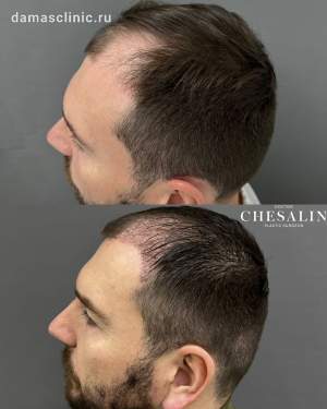 11 дней с момента трансплантации волос в височно-лобную зону на плановом осмотре. Работа доктора Ивана Павловича Чесалина