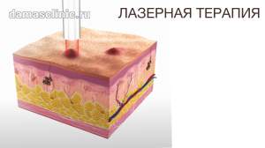 Лазеротерапия - это точечное воздействие на пораженные участки кожи