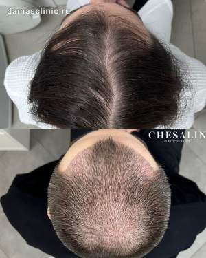 Трансплантация волос в зону височно-лобной и затылочной зоны до и на 10 сутки после на плановом осмотре. Работа доктора Ивана Павловича Чесалина