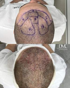 Мужская трансплантация волос до и сразу после