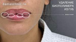 Как выглядит фиброз тканей губ, вызванный биополимерным гелем