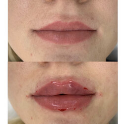 Коррекция формы губ филером до и после