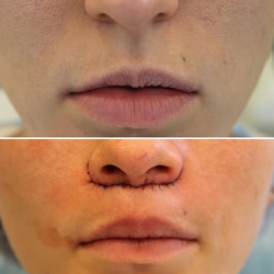 Результат до и после пластики губ Булхорн, через 5 дней после операции.