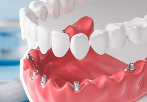 Акция на имплантацию зубов ALL IN 4 на имплантах нового поколения Dentium Super Line