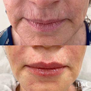 Comprehensive rejuvenation of the face and perioral zone. Biorevitalization, botulinum therapy and contouring with a soft filler