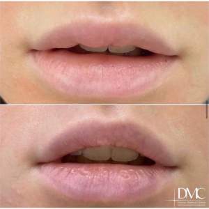 Correction of a previously unsuccessfully injected filler
