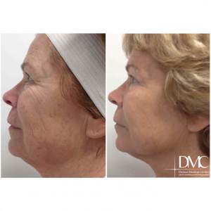 Face lifting on the Infini apparatus. Before and 8 months after the procedure