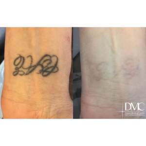 Laser removal of a black and white tattoo