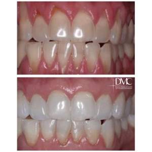 Gingival plasty with recession. Before and after correction