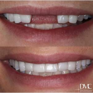 Natural implantation of two central teeth