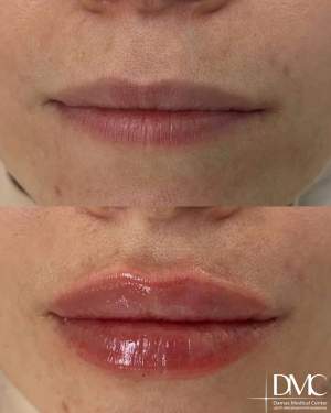 Коррекция объёма и формы губ: фото до после