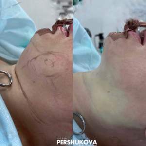 Вайзер-липосакция подбородка (до и сразу после операции). Работа Анны Петровны Першуковой