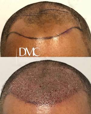 Мужская пересадка волос в височно-лобную зону: до и сразу после. Работа доктора Альбины Дахировны Тебуевой